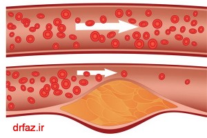 کلسترول خون