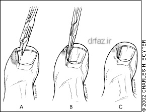 جراحی ناخن