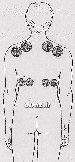 بادکش ریه