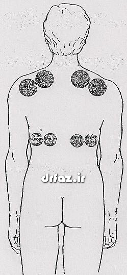 بادکش ریه