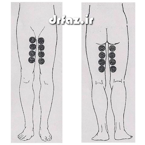 بادکش کشاله ران