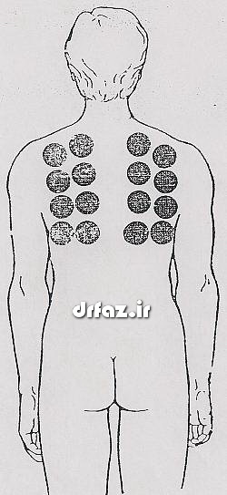 بادکش ریه